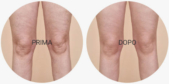 prima e dopo il trattamento